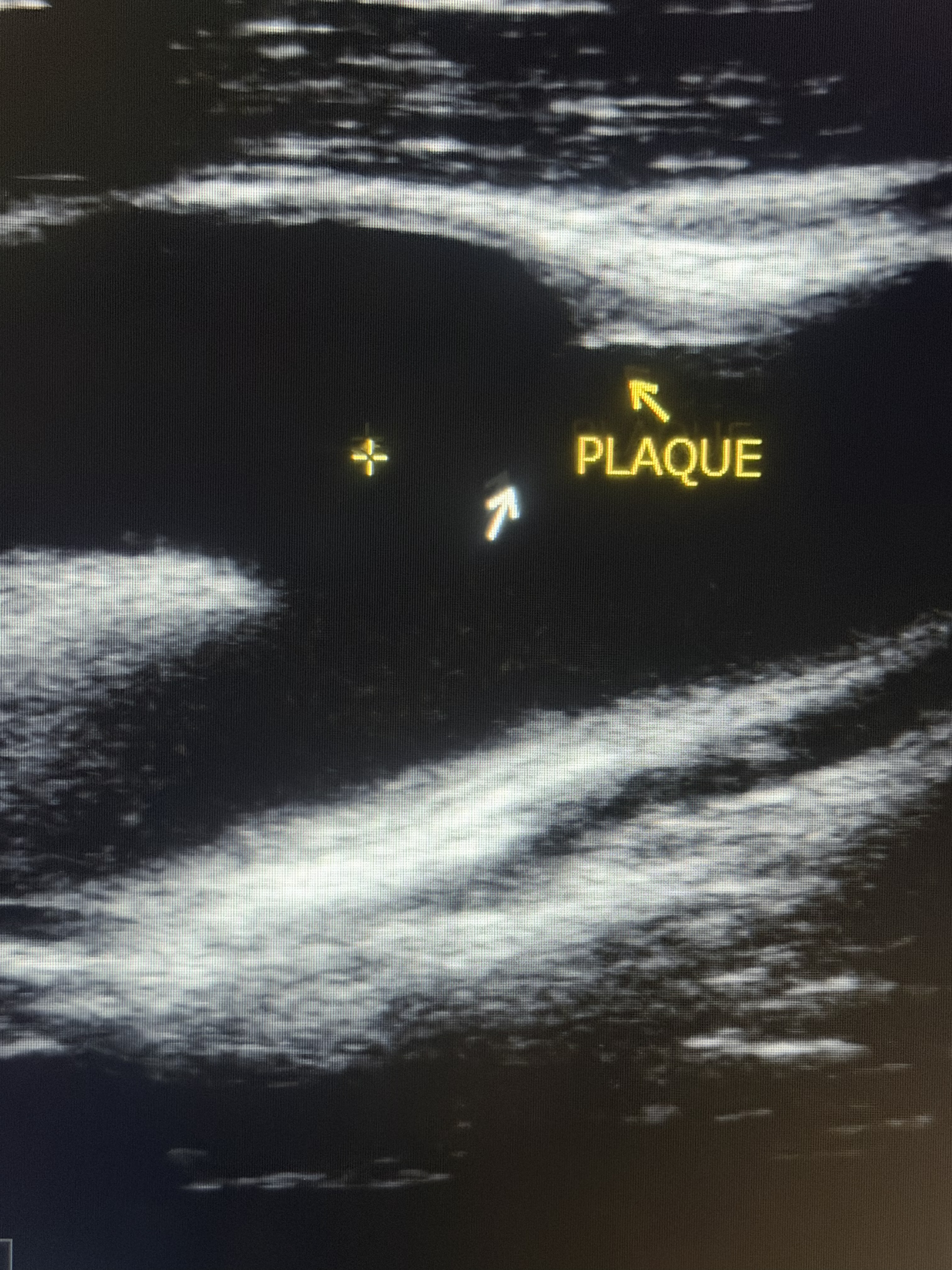 Carotid ultrasound image showing detected arterial plaque